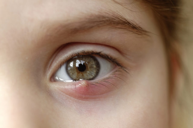 Chalazion