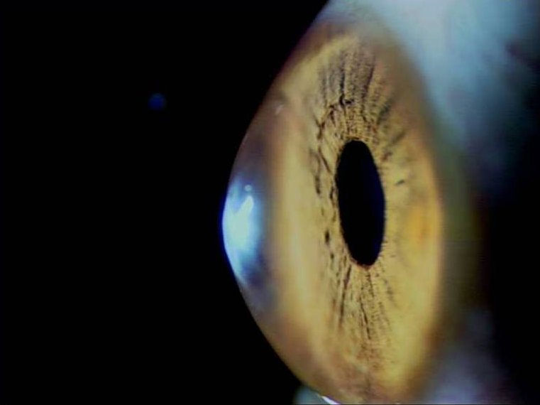 What is Keratoconus?