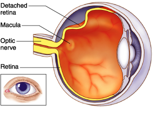 Retinal Detachment – Can it Happen to Me?