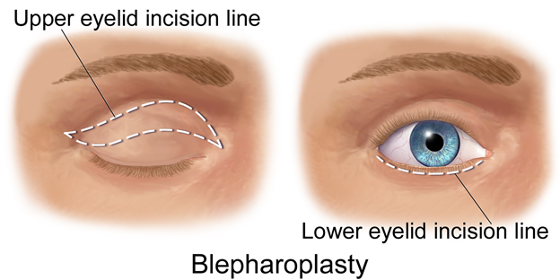 Is Eyelid Surgery Covered By Health Insurance