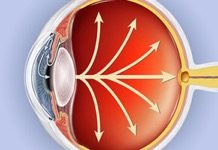 Primary Open Angle Glaucoma