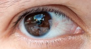 Pterygium Surgery | Cornea Center | Milan Eye Center