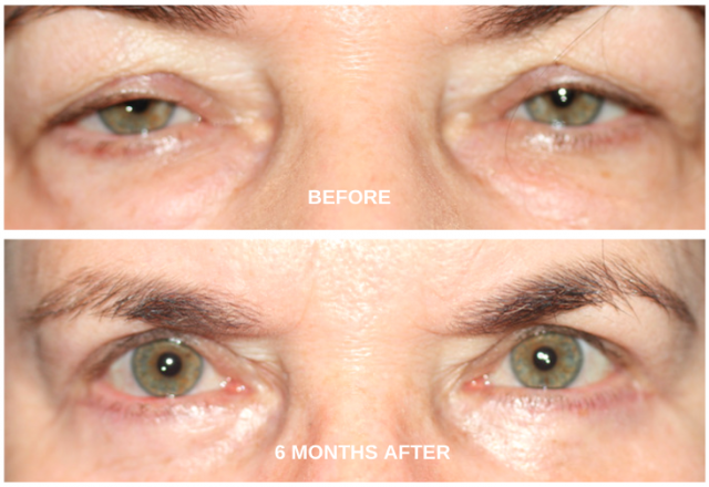 Before and After ptosis eyelid surgery