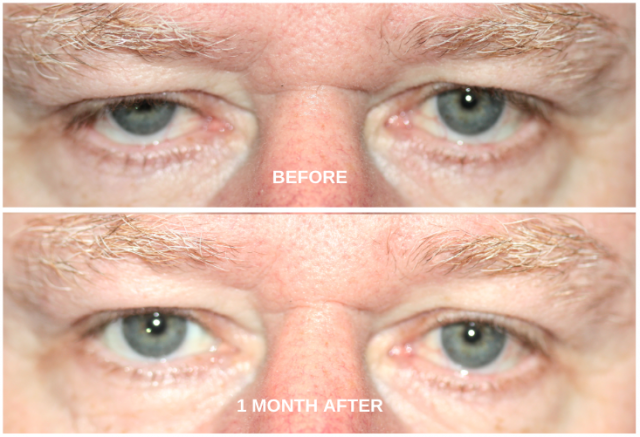 Correcting droopy eyelids- before and after