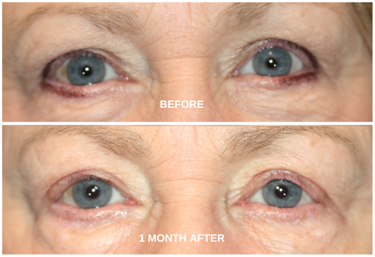 Before and after ptosis eye surgery