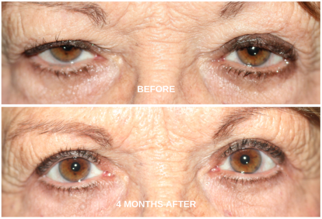 After ptosis surgery and after blepharoplasty