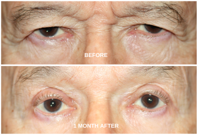 Before Eyelid Surgery and After