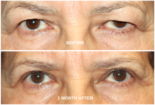 Bilateral Upper Blepharoplasty before and after photos