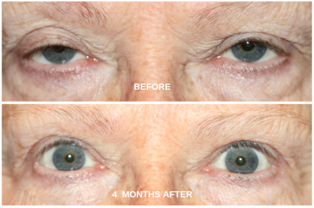Eyelid correction surgery before & after