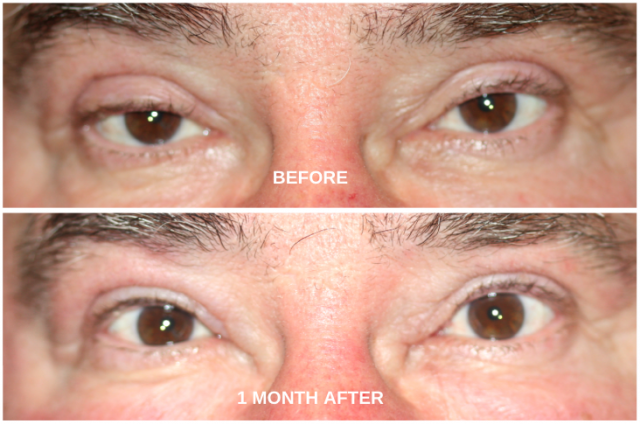 Before and after eyelid surgery to fix droopy lids