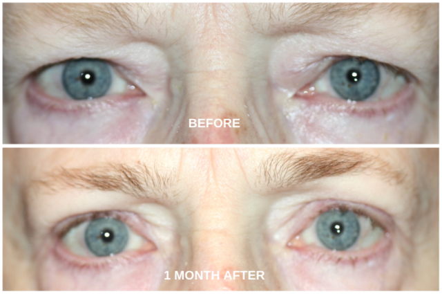 Blepharoplasty after Ptosis Surgery Progress