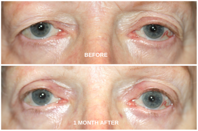 Progression Pictures of Eyelid Correction Surgery