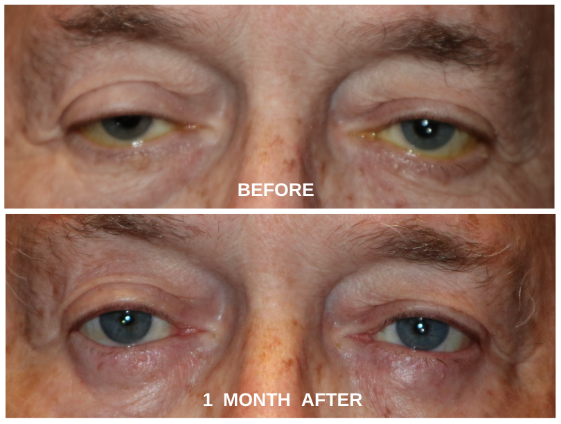 slsi.lk how long for sulfatrim to work Congratulate, do eye drops