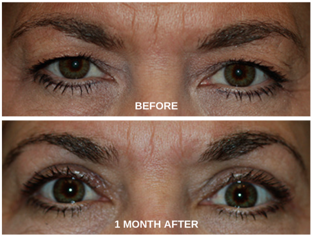 Blepharoplasty Before and After Photos