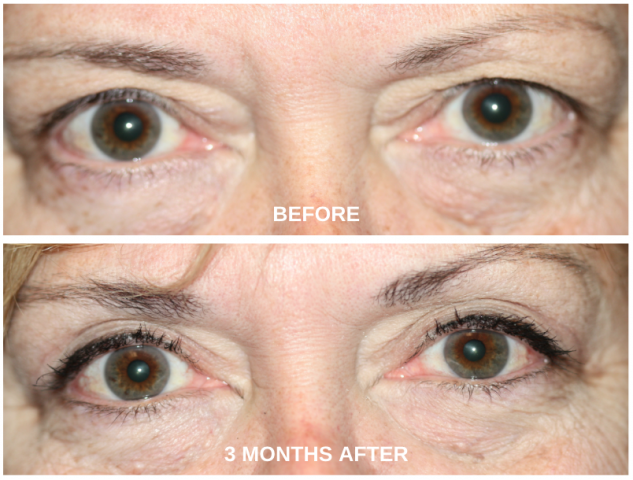 Before & 3 months after BULB Surgery