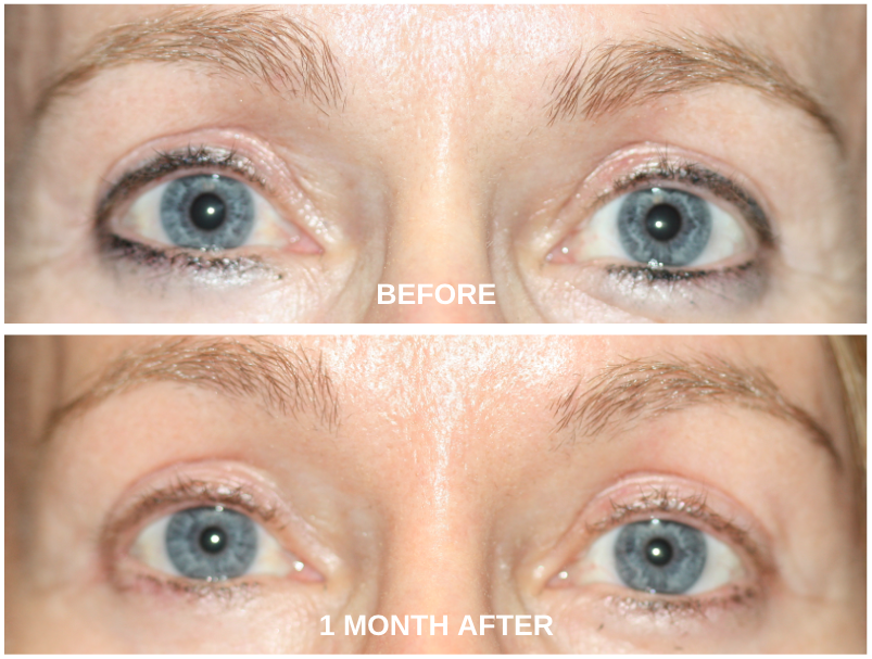 Before and After Cosmetic Upper Blepharoplasty