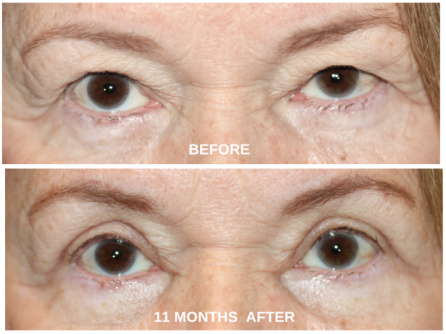 Before and After Upper Eye Lid Surgery