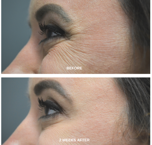crows feet