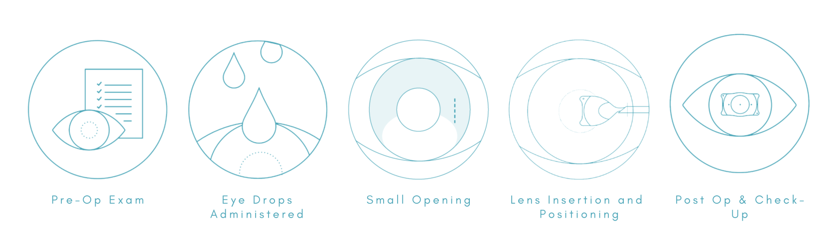 EVO ICL procedure stages overview