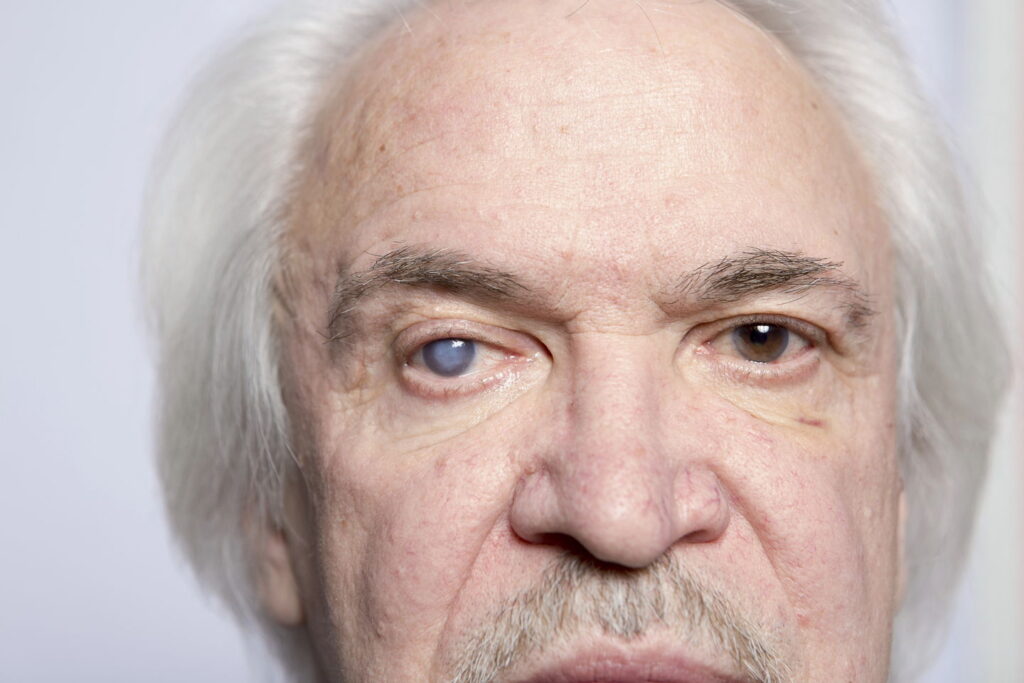Why Choose Milan Eye Center for Cataract Surgery in Atlanta