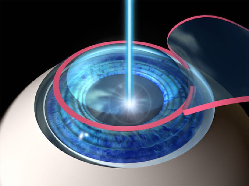 lasik-atlanta-during-the-surgery