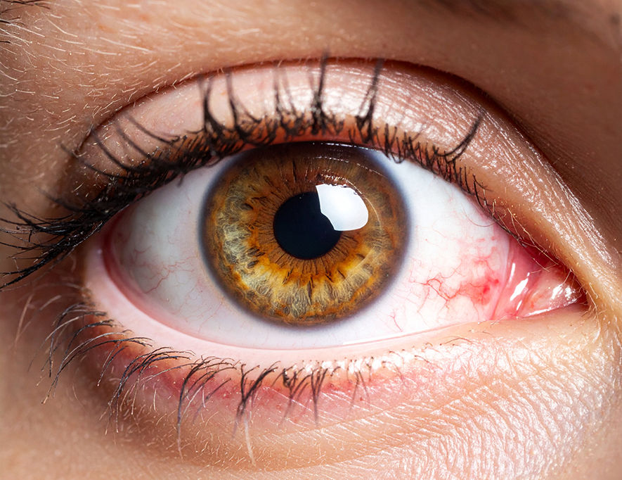 Different-Types-of-Glaucoma