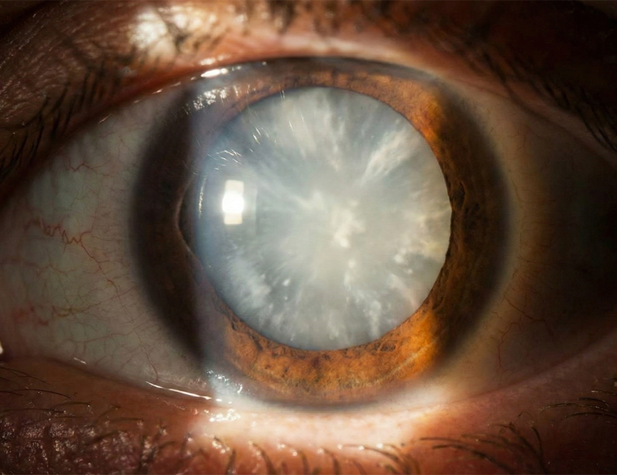 Types-and-Grades-of-Cataracts